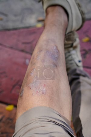 Nahaufnahme eines von Dermatitis (Eksem) betroffenen Fußes)