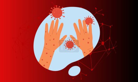 Illustration for Monkeypox virus banner for awareness and alert against disease spread, symptoms or precautions. - Royalty Free Image