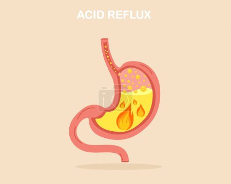 Sufrimiento de síntomas de ERGE con reflujo ácido acidez estomacal ardor de estómago con ácido ardiente dentro del sistema digestivo problema de gastritis.