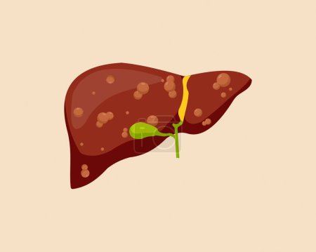 Ilustración de Humano dañado Hígado graso insalubre órgano humano concepto de salud. - Imagen libre de derechos