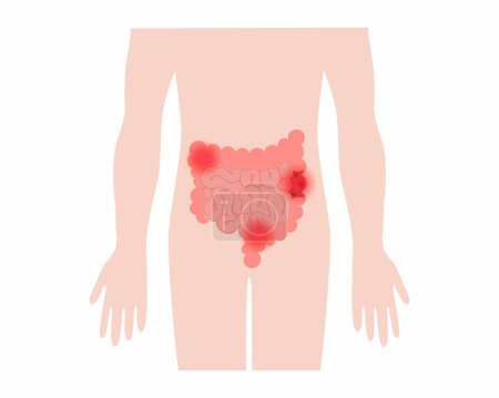 Téléchargez les illustrations : Maladie inflammatoire de l'intestin Douleurs abdominales dans le côlon Anatomie des gros intestins humains - en licence libre de droit