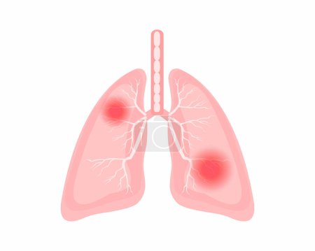 Illustration for Chest discomfort Pain in the lungs human body lungs anatomy. - Royalty Free Image