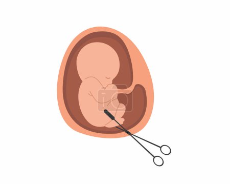 Embryo mit chirurgischer Pinzette stoppt Abtreibungskampagne Fehlgeburten und Schwangerschaftsprobleme
