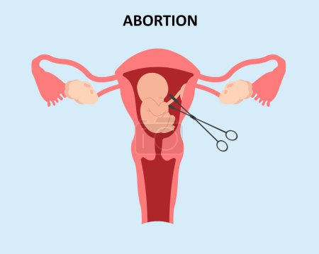Ein Embryo im Mutterleib und eine chirurgische Pinzette Abtreibung Fehlgeburt Verlust Schwangerschaftsvektor Illustration