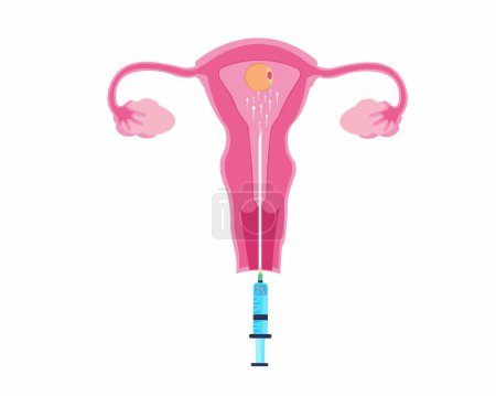 Unfruchtbarkeitsbehandlung mit künstlicher Befruchtung Human Reproductive Technology Vektor Illustration.