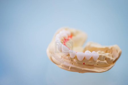 Photo for Veneers presented on a false jaw,isolated - Royalty Free Image
