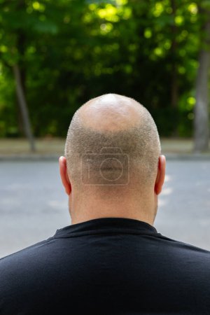 Photo for Close-up of a male head with little hair or alopecia. Outdoor vertical photography outdoors with natural light - Royalty Free Image