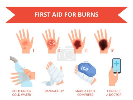Illustration for Burn skin. First treatment human hand fire or chemical destruction injury graviera skin safety for persons vector infographic. Injury degree, bandage on damage body, classification illustration - Royalty Free Image