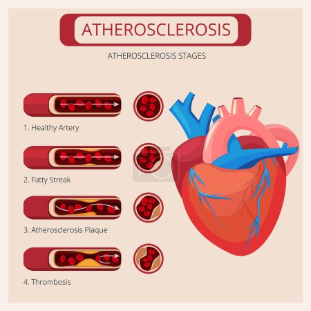 Ilustración de Etapas de aterosclerosis. Los trombos del corazón atacan las infografías médicas vectoriales del sistema circulatorio sanguíneo. Arteria del colesterol, corazón humano y sistema cardiovascular ilustración - Imagen libre de derechos