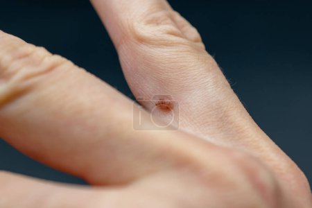 Téléchargez les photos : Papillome au doigt, verrue commune Verruca vulgaris une verrue plate sur une main, papillomavirus humain HPV - en image libre de droit