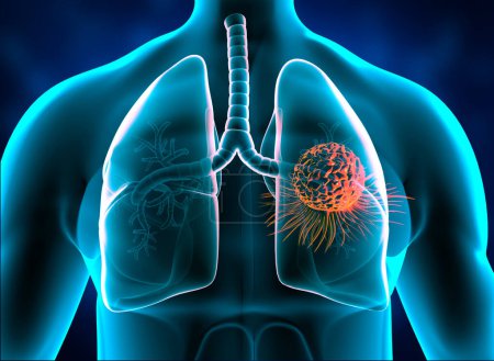 Foto de Cáncer de pulmón, tumor en pulmones. ilustración 3d - Imagen libre de derechos