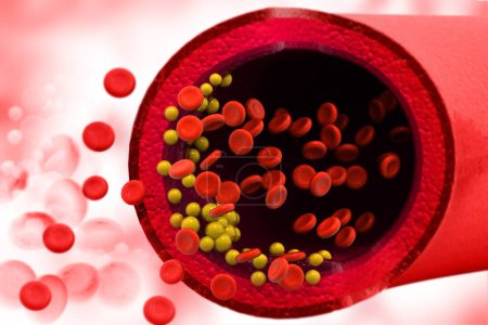 Téléchargez les photos : Plaque de cholestérol dans les vaisseaux sanguins. Une formation médicale. Illustration 3d - en image libre de droit