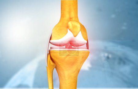 Foto de Artritis articular de rodilla. Dolor agudo. ilustración 3d - Imagen libre de derechos