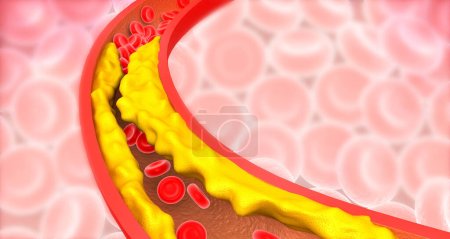Artery blocked with bad cholesterol. clogged arteries, coronary artery plaque. 3d illustration	