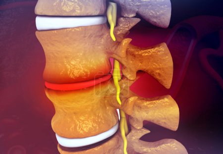Photo for Human Spine With Slipped Disc on medical science background. 3d illustration - Royalty Free Image