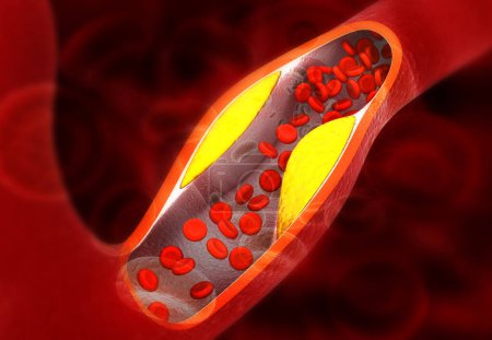Téléchargez les photos : Cholestérol bloquant l'artère. Illustration 3d - en image libre de droit