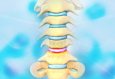 Problema de disco de la columna vertebral humana. ilustración 3d