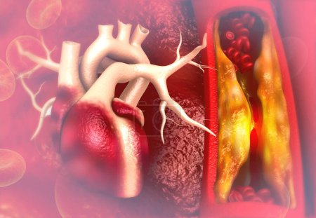 Téléchargez les photos : Plaque de cholestérol dans l'artère avec anatomie cardiaque humaine. Illustration 3d - en image libre de droit