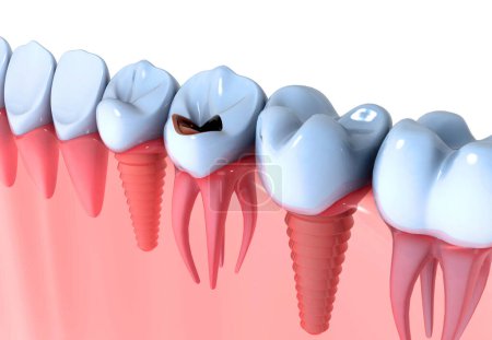 Foto de Implantes dentales en lugar de dientes dañados. 3d renderizar - Imagen libre de derechos