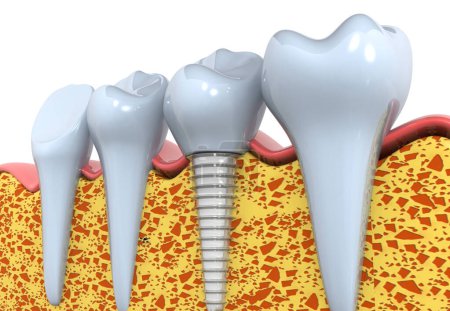 Téléchargez les photos : Implants dentaires au lieu de dents endommagées. 3d rendu - en image libre de droit
