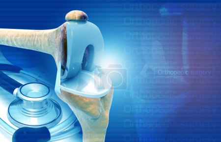 Photo for Knee joint replacement. medical background concept. 3d illustration - Royalty Free Image