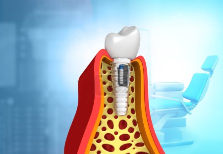 Téléchargez les photos : Concept d'implant dentaire sur fond médical. Illustration 3d - en image libre de droit