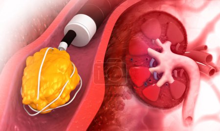 Photo for Kidney stone removal concept background. 3d illustration - Royalty Free Image