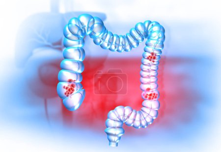 Concepto de cáncer de colon en los antecedentes médicos. ilustración 3d 