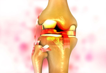 Photo for Knee joint arthritis on abstract background. 3d render - Royalty Free Image