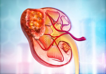 Photo for Diseased human kidney on science background. 3d illustration - Royalty Free Image