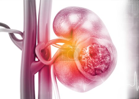Foto de Un riñón humano enfermo con antecedentes científicos. ilustración 3d - Imagen libre de derechos