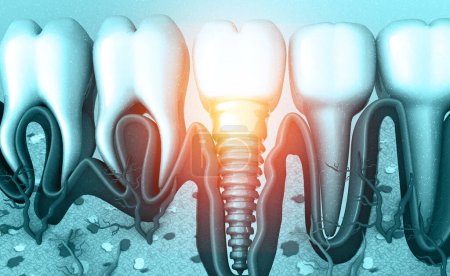 Foto de Implante dental, concepto dental. ilustración 3d - Imagen libre de derechos