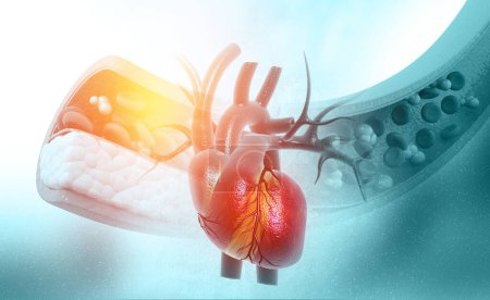 Téléchargez les photos : Cholestérol bloqué artère avec coeur. Illustration 3d - en image libre de droit