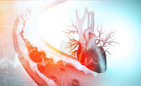 Téléchargez les photos : Le cholestérol bloque l'artère avec le cœur. Illustration 3d - en image libre de droit