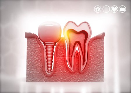 Téléchargez les photos : Implants dentaires, concept dentaire. Illustration 3d - en image libre de droit