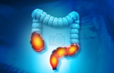Foto de Modelo de anatomía del intestino grueso sobre fondo médico. ilustración 3d - Imagen libre de derechos