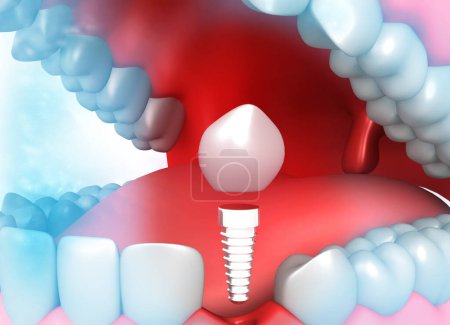 Photo for Human dental tooth implant. 3d illustration - Royalty Free Image