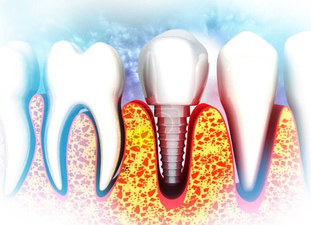 Photo for Human dental tooth implant. 3d illustration - Royalty Free Image