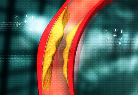 Photo for Cholesterol blocked artery on medical background. 3d illustration - Royalty Free Image