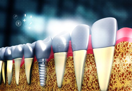 Téléchargez les photos : Implants dentaires, antécédents médicaux. Illustration 3d - en image libre de droit