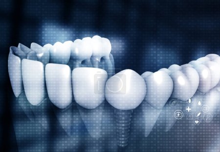 Téléchargez les photos : Implants dentaires, dents humaines sur fond scientifique. Illustration 3d - en image libre de droit