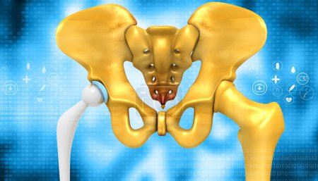 Photo for Human hip replacement concept on medical background. 3d illustration - Royalty Free Image