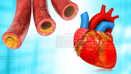 Téléchargez les photos : Coeur humain avec artères obstruées. Illustration 3d - en image libre de droit