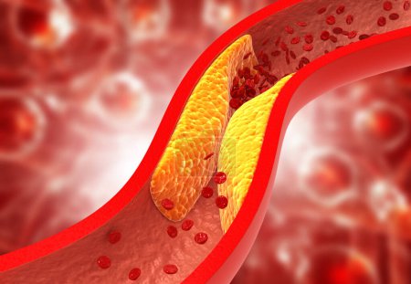 Verstopfte Arterien, Cholesterinplaque in der Arterie. 3D-Illustration