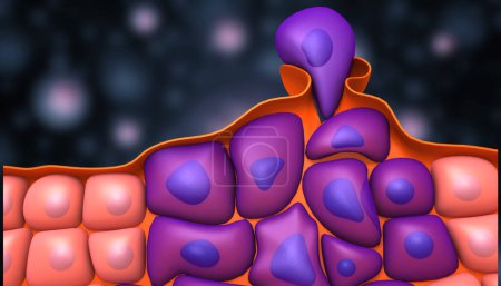 Foto de Crecimiento de células cancerosas. ilustración 3d - Imagen libre de derechos