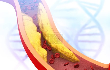 Foto de Arterias obstruidas. placa arterial. Formación médica. ilustración 3d - Imagen libre de derechos