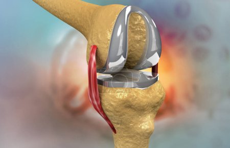 Photo for Steel knee cap on knee joint. 3d illustration - Royalty Free Image