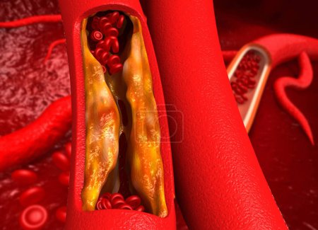 Photo for Clogged arteries,Blocked blood vessel, artery with bad cholesterol. 3d illustration - Royalty Free Image