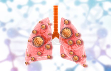 Téléchargez les photos : Infection virale dans les poumons humains. Illustration 3d - en image libre de droit