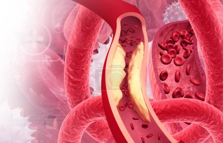 Foto de Placa de colesterol en la arteria. Arteria bloqueada. ilustración 3d - Imagen libre de derechos